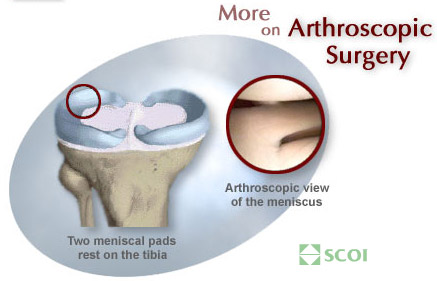 arthroscopy-meniscus