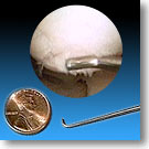 arthroscopy-penny