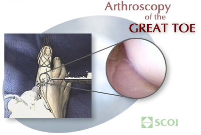 arthroscopy-toe