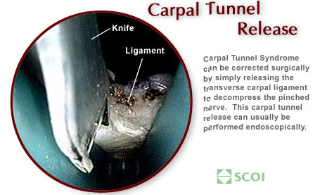 carpal-tunnel-release